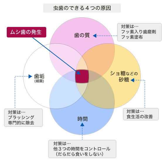 虫歯のできる４つの原因